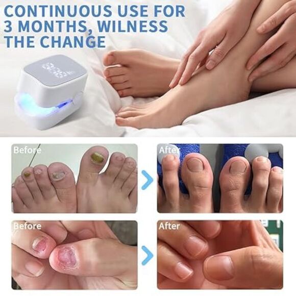 Nail Fungus Cleaning Laser Device 940nm Infrared Light + 500nm Blue Light... - Picture 5 of 15